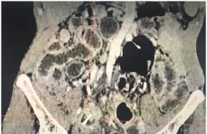 Advertencia: hombre necesita que le extraigan un órgano tras cometer un error común al comer pollo