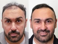 La ex estrella del Aston Villa muestra increíbles resultados de trasplante de cabello que “lo han hecho sentir cinco años más joven”