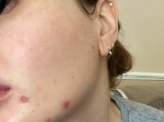 He pasado 10 años luchando contra una afección de la piel que afecta a miles de personas. Estos son los desencadenantes cotidianos que ignoré y que empeoraban mi piel… y cómo finalmente los traté