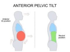 Los científicos dicen que el tamaño de tu trasero podría ser un signo oculto de autismo